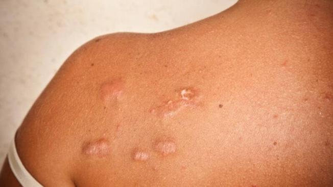 Cuidado de la piel en cicatrices queloides o hipertróficas