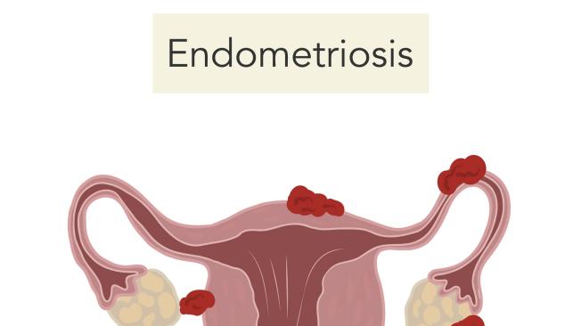 ¿qué Es La Endometriosis Y Cuáles Son Sus Síntomas Y Su Tratamiento?