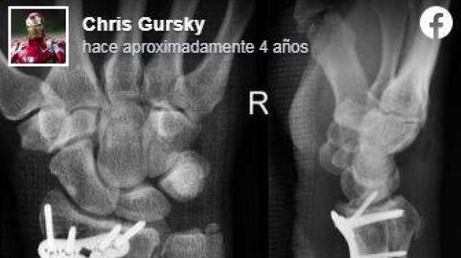 Gursky subió en sus redes la radiografía de la fractura.