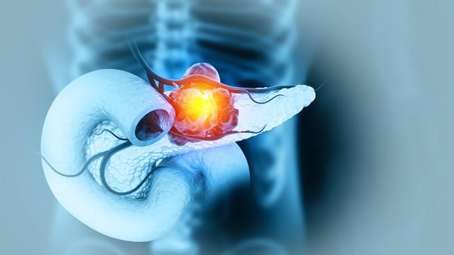 El cáncer de páncreas es difícil de detectar.