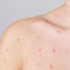 Los virus de la viruela pueden transmitirse no solo a través del contacto directo con los fluidos corporales.