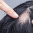 Los hombres son más propensos a sufrir de alopecia.