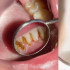 Remedios caseros para combatir el sarro dental: ¿cuáles son los más efectivos?