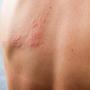 Uno de los signos de contagio son las pústulas en diferentes zonas del cuerpo.