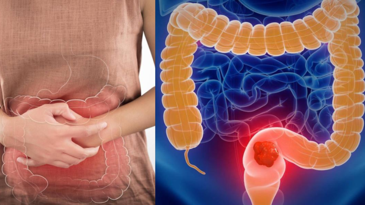 Cáncer de colon: sepa cuánta fibra debe comer al día para prevenirlo y dónde encontrarla