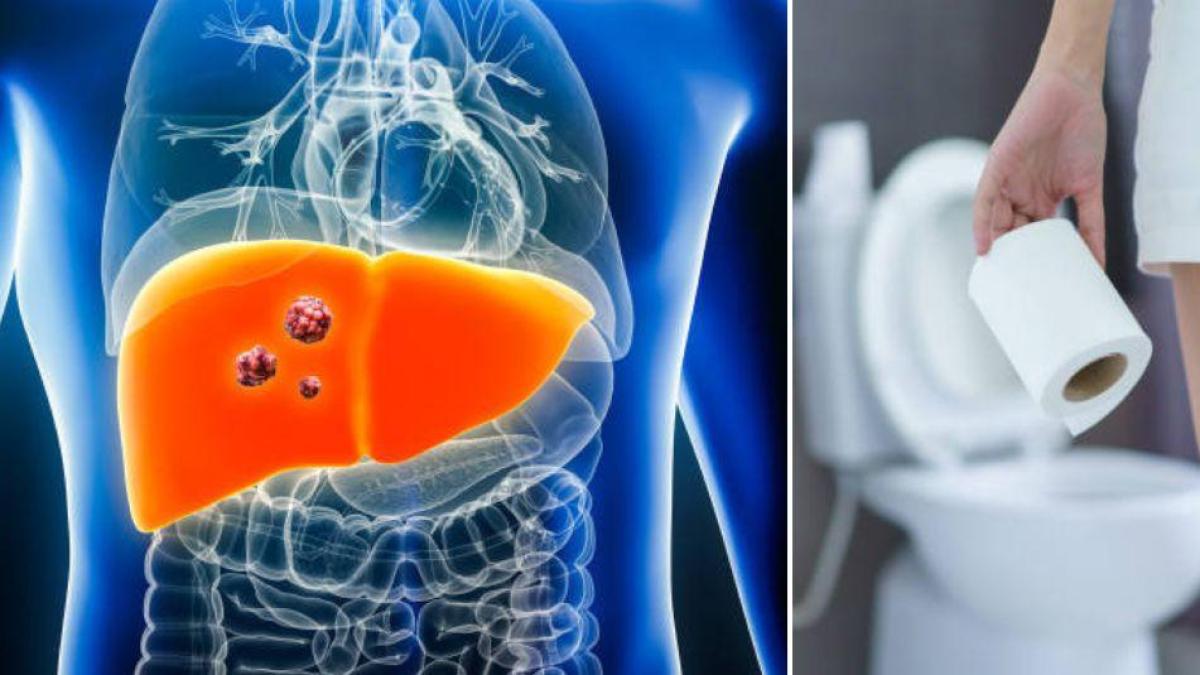 Dos síntomas del cáncer de hígado que se pueden identificar mientras está en el baño