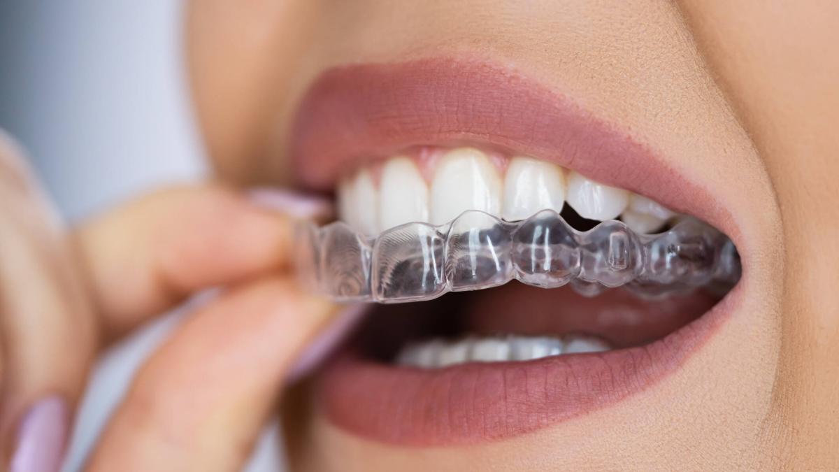 Odontología: ¿Qué son los retenedores dentales y cuál es su costo en ...