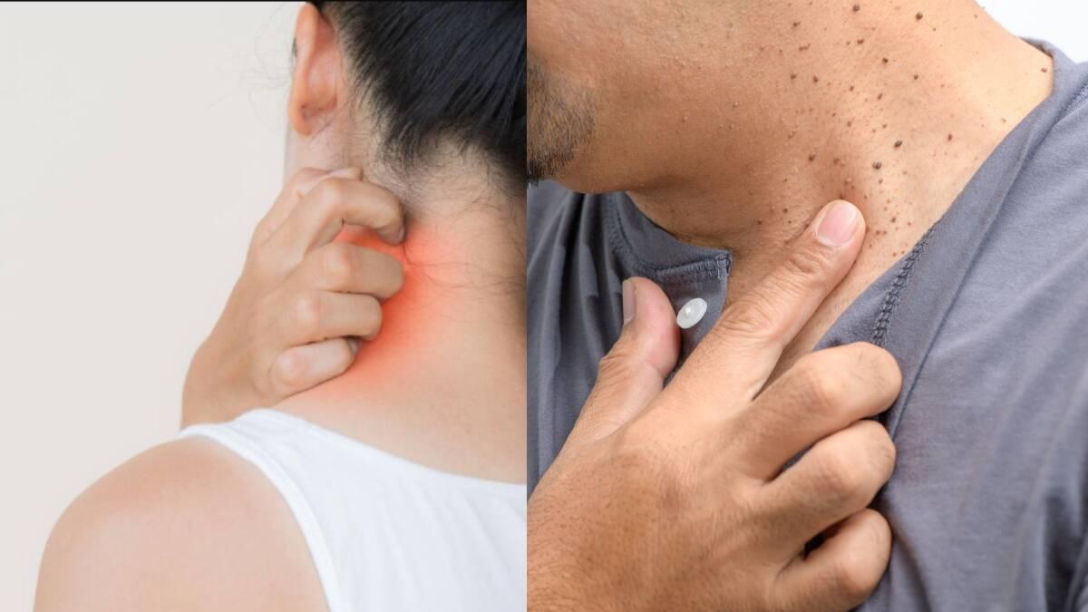 Manchas y pecas en el cuello que revelan diabetes y resistencia a la