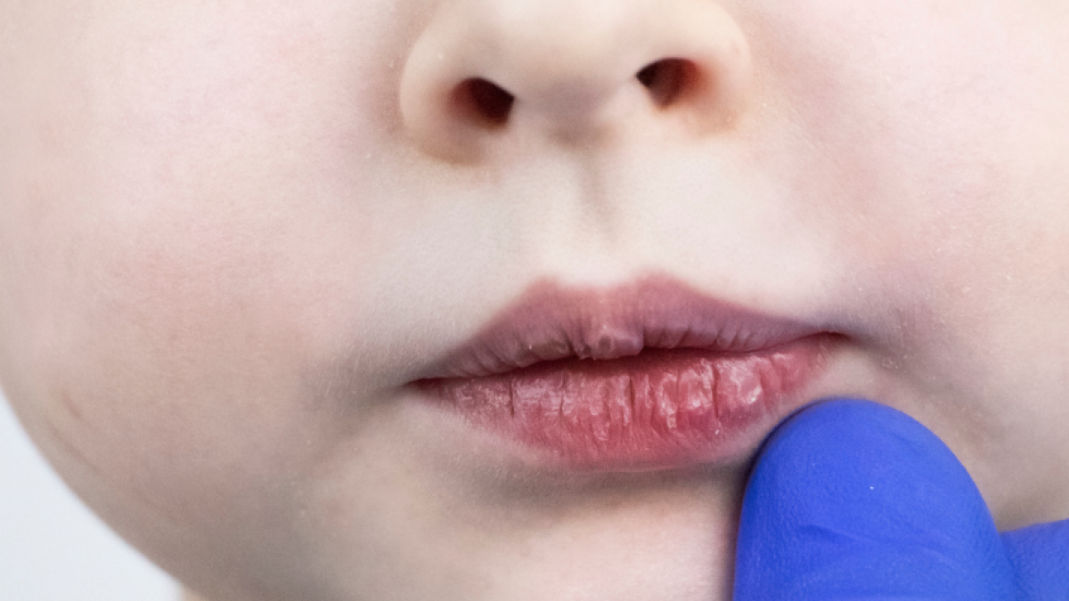 ¿Cómo curar los labios agrietados en niños?