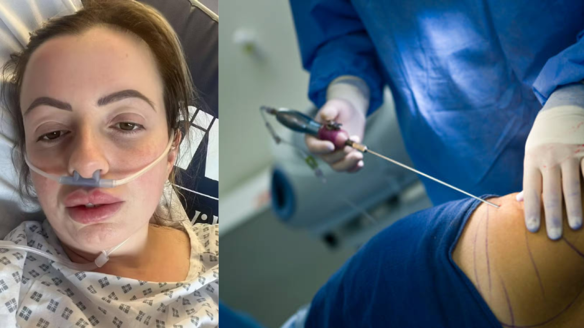 'Enfermedad carnívora': mujer sufre una infección grave y una insuficiencia orgánica después de una liposucción en Turquía