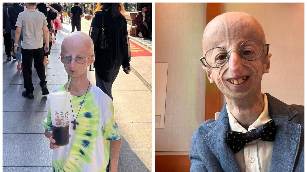 Murió Sammy Basso, científico italiano que padecía progeria e investigaba sobre su extraña enfermedad