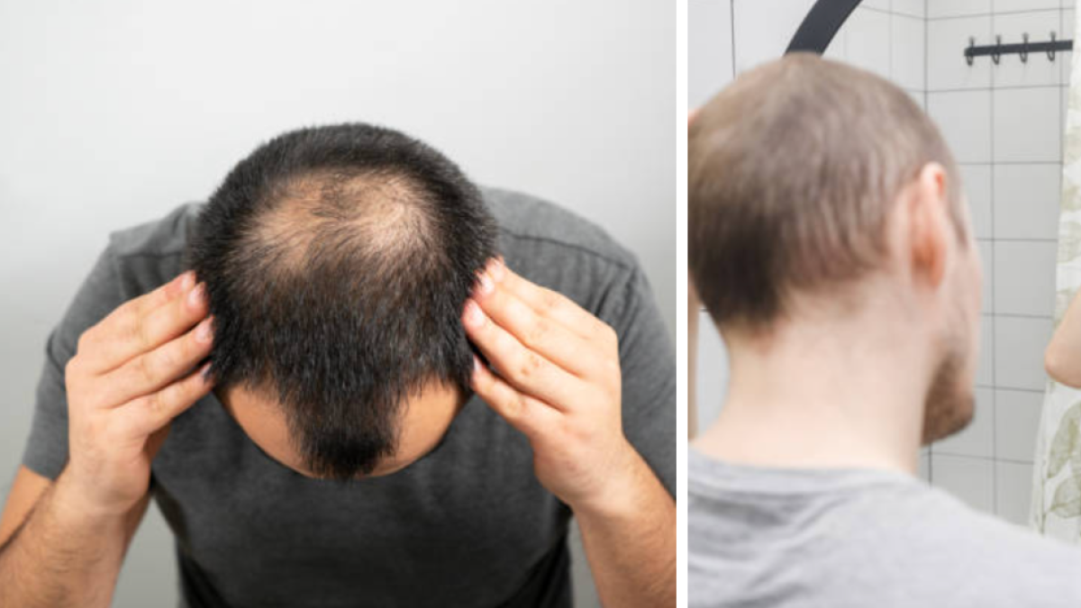 Descubren gel que recupera el pelo: adiós a la calvicie hereditaria con esta crema