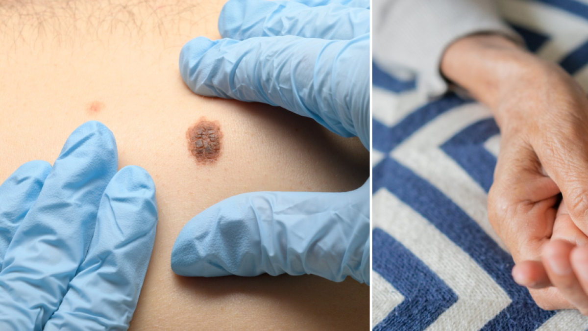 Esta es la proteína que tienen en común el melanoma, un tipo de cáncer de piel, y el Parkinson: estudio