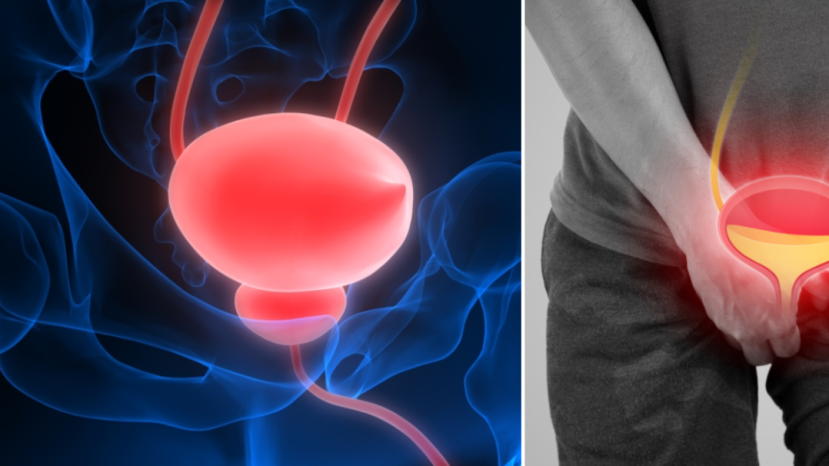 Tres enfermedades que pueden afectar la próstata y sus síntomas: no solo es el cáncer