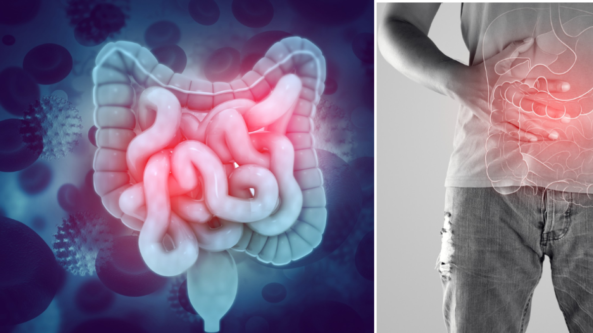 ¿Cómo saber si tiene el colon obstruido? Algunos síntomas que podrían alertarle