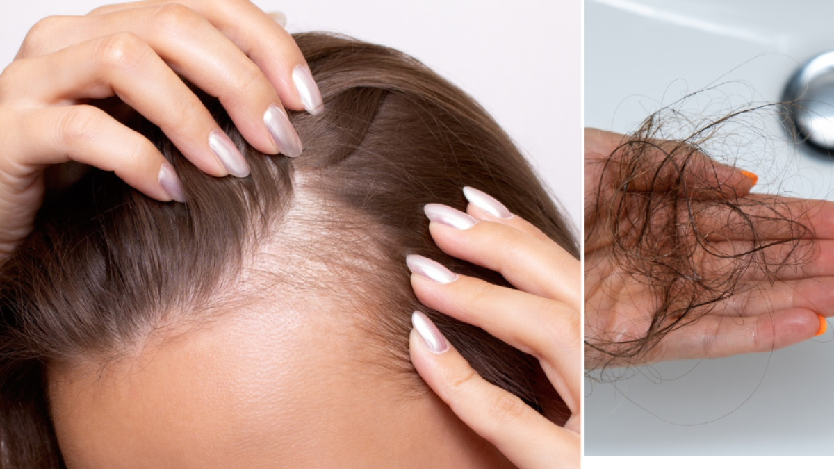¿Qué causa la alopecia androgénica femenina? Cuando las mujeres se quedan sin pelo: síntomas, tratamiento