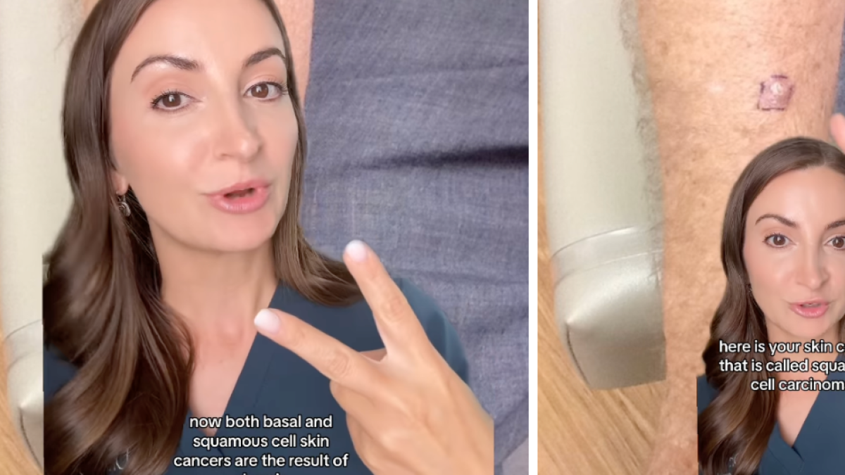 Dermatóloga revela la mancha de cáncer que muchas personas confunden con una picadura de insecto: 'Es prevenible'