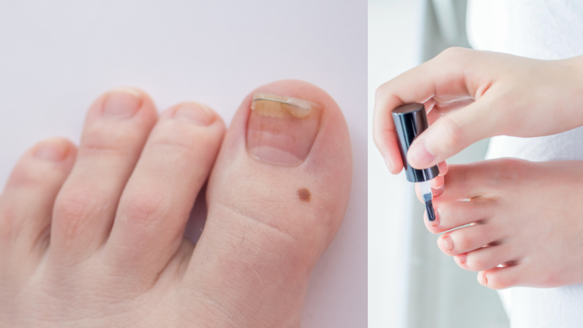Médicos confundieron el cáncer de piel de una mujer con una infección por hongos en las uñas del pie