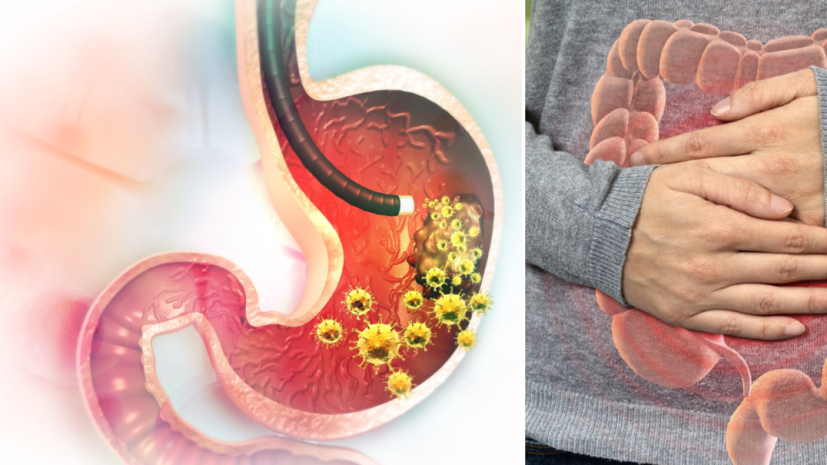 Los síntomas del cáncer de estómago que aparecen en etapas iniciales y quiénes tienen más riesgo de padecerlo