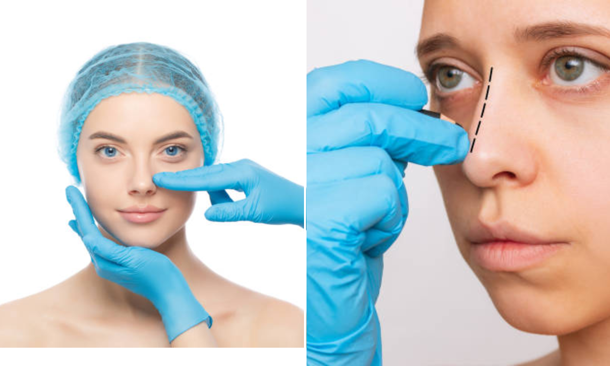 Rinoplastia cuándo es recomendable realizar esta cirugía estética Expertos responden