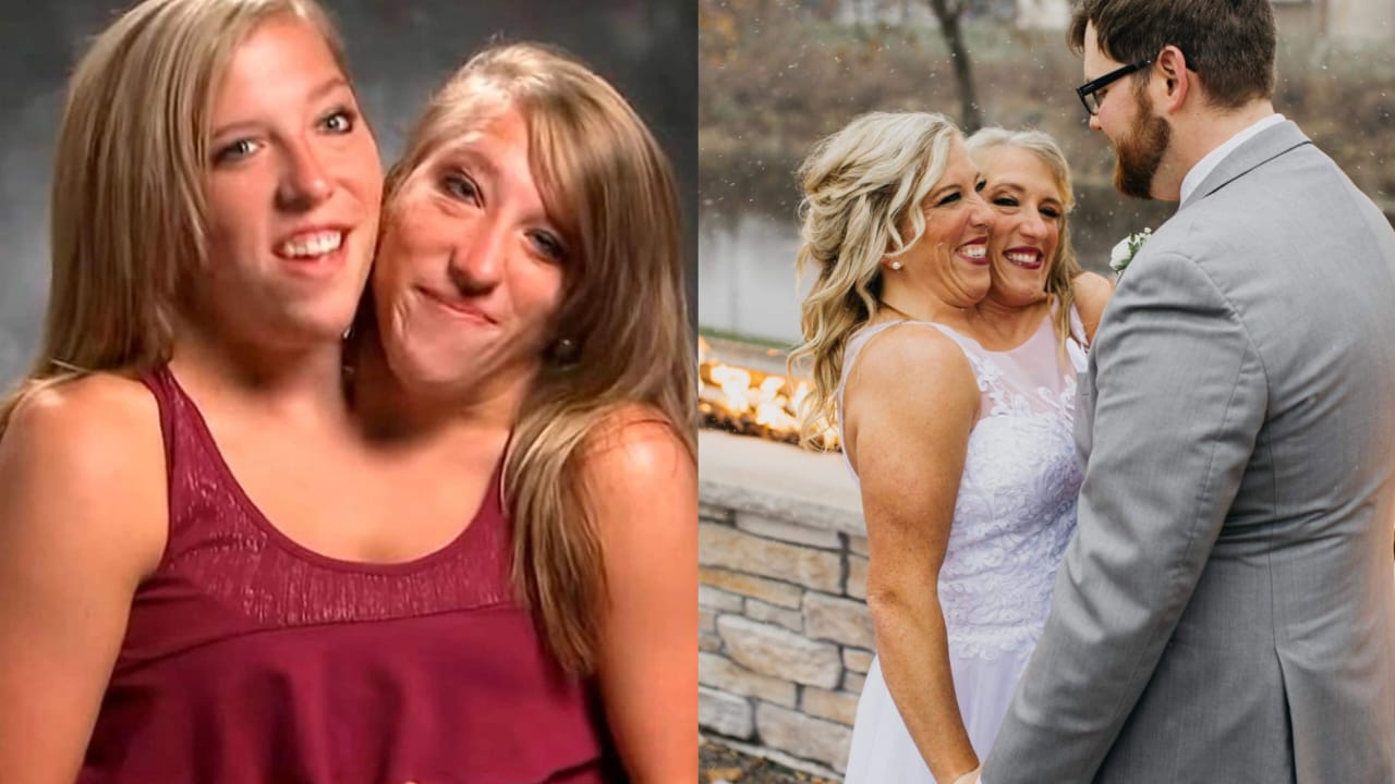 Abby y Brittany Hensel