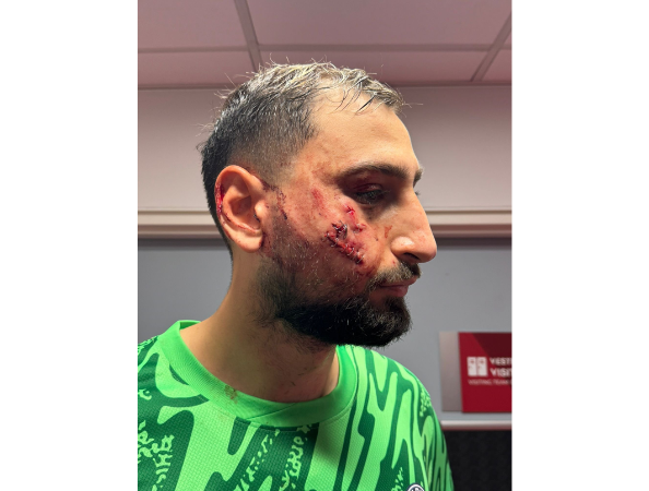 Donnarumma recibió varias cicatrices en su rostro.