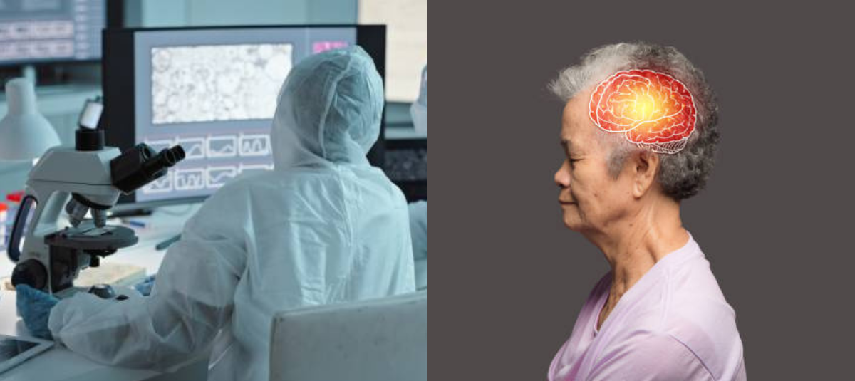 Alzheimer
