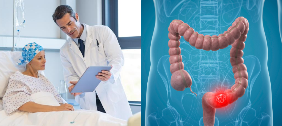 Científicos descubren que un tipo de pacientes con cáncer de colon tienen mejores tasas de supervivencia que los otros