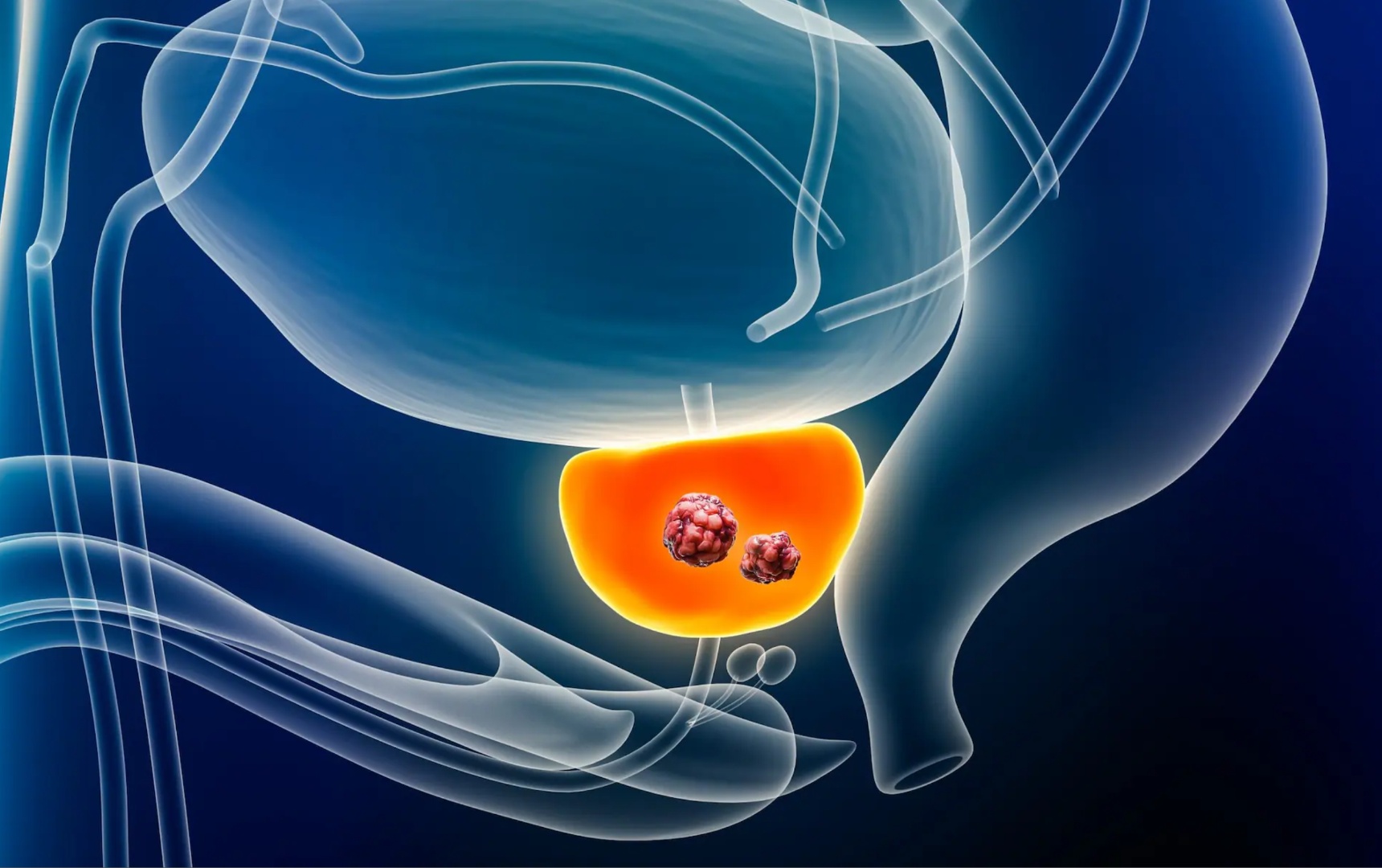 El Cáncer de Próstata es común en Hombres.