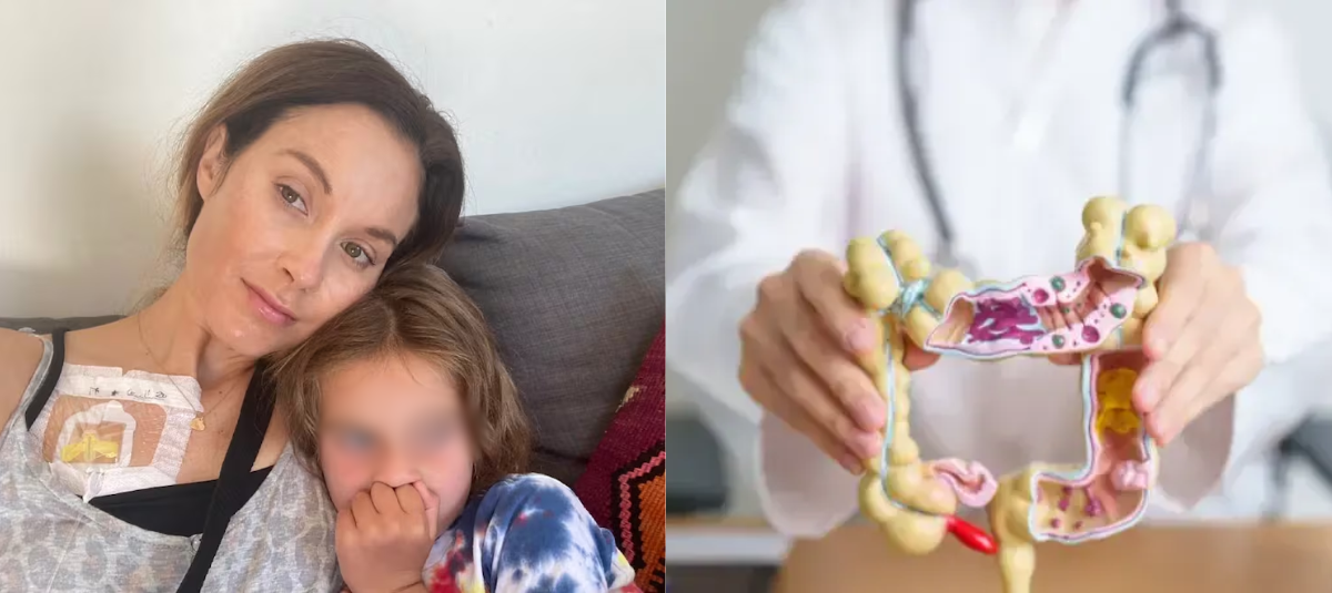 Mujer de 34 Años Pensó que Tenía Síndrome del intestino irritable, Pero era Cáncer de colon en etapa 4 y más de 100 pélipos