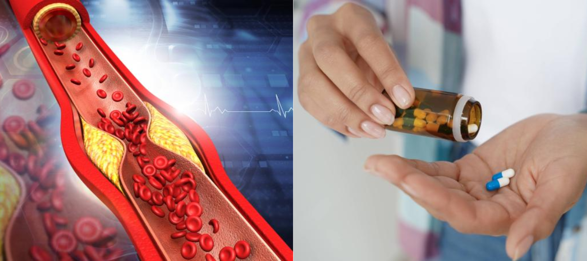 Estudio Descubre un fármaco experimental que podría eliminar el colesterol de las células vasculares y frenar la aterosclerosis